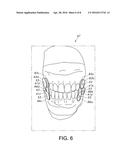 Retainerless Orthodontic Dental Implant System diagram and image