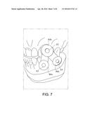 Retainerless Orthodontic Dental Implant System diagram and image