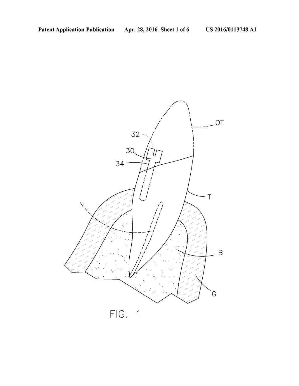 DENTAL PROSTHESIS FOR CATTLE - diagram, schematic, and image 02