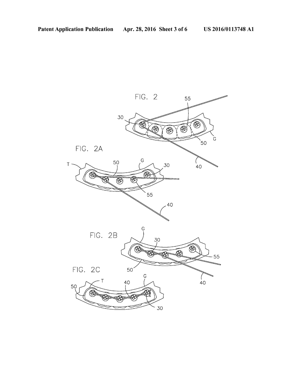 DENTAL PROSTHESIS FOR CATTLE - diagram, schematic, and image 04