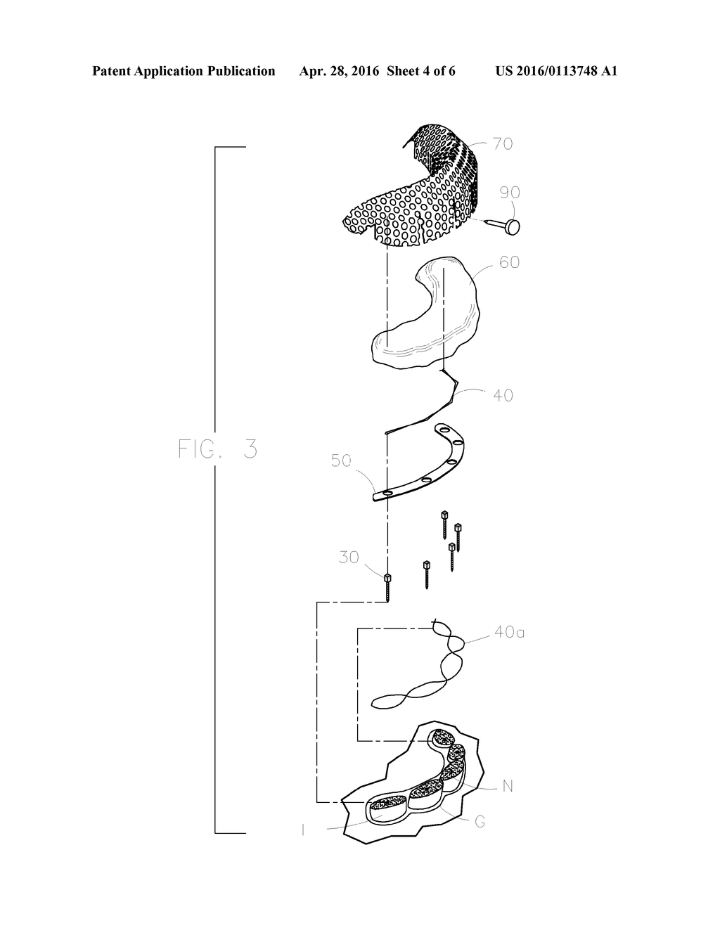 DENTAL PROSTHESIS FOR CATTLE - diagram, schematic, and image 05