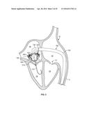 SYSTEMS AND METHODS FOR HEART VALVE THERAPY diagram and image