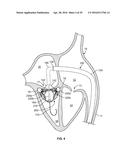 SYSTEMS AND METHODS FOR HEART VALVE THERAPY diagram and image