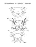 SYSTEMS AND METHODS FOR HEART VALVE THERAPY diagram and image