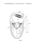 SYSTEMS AND METHODS FOR HEART VALVE THERAPY diagram and image