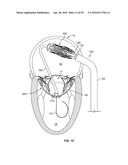 SYSTEMS AND METHODS FOR HEART VALVE THERAPY diagram and image