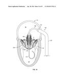 SYSTEMS AND METHODS FOR HEART VALVE THERAPY diagram and image