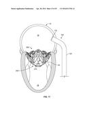 SYSTEMS AND METHODS FOR HEART VALVE THERAPY diagram and image