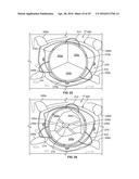 SYSTEMS AND METHODS FOR HEART VALVE THERAPY diagram and image