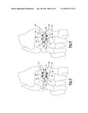 METHOD AND APPARATUS FOR BONE FIXATION diagram and image