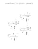 Intervertebral Implant with Blades for Connecting to Adjacent Vertebral     Bodies diagram and image