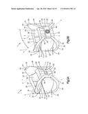 Intervertebral Implant with Blades for Connecting to Adjacent Vertebral     Bodies diagram and image