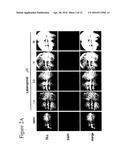 COMPOSITIONS COMPRISING A PROSTAGLANDIN FOR TREATING NEUROPSYCHIATRIC     CONDITIONS diagram and image