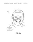 PATIENT INTERFACE DEVICES WITH ADHESIVE ATTACHNMENT diagram and image