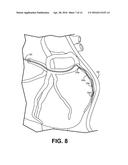 CORONARY SINUS MEDICAL ELECTRICAL LEAD diagram and image