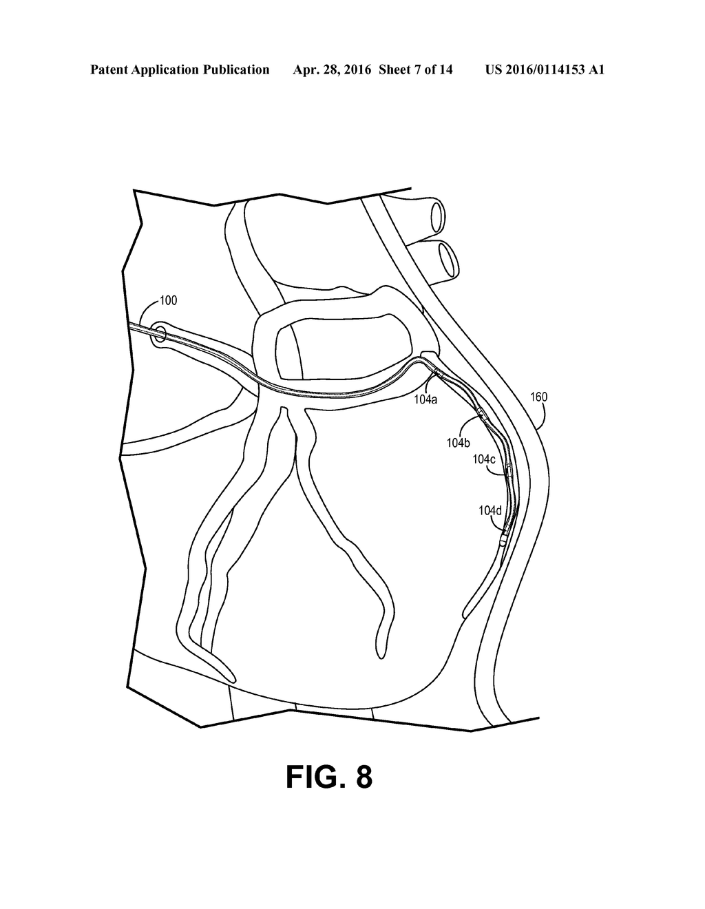 CORONARY SINUS MEDICAL ELECTRICAL LEAD - diagram, schematic, and image 08