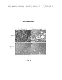 USE OF LASERS FOR TREATING AND REVERSING FIBROSIS diagram and image
