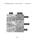 BIOMARKERS FOR DIFFERENTIATING MELANOMA FROM BENIGN NEVUS IN THE SKIN diagram and image