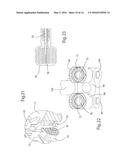 Drilling/Milling Guide and Keel Cut Preparation System diagram and image