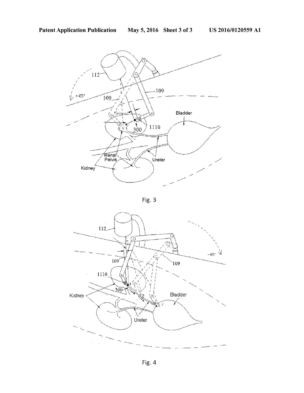 APPARATUS FOR REMOVING CALCULUS IN VITRO - diagram, schematic, and image 04