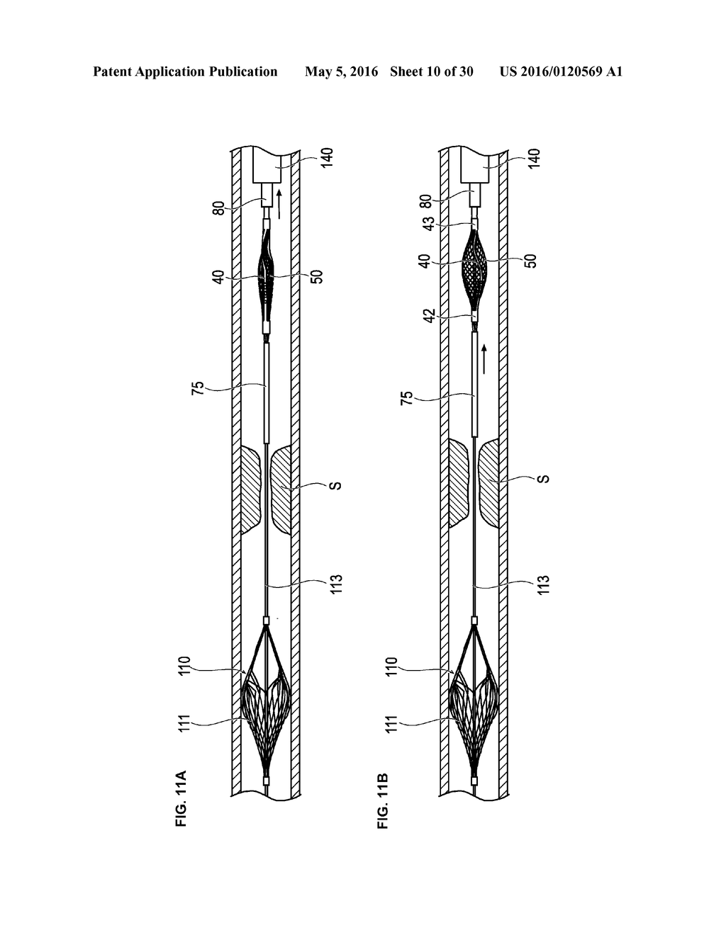 MEDICAL DEVICE AND TREATMENT METHOD - diagram, schematic, and image 11