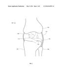 THERMALLY TREATING TORN TISSUE diagram and image