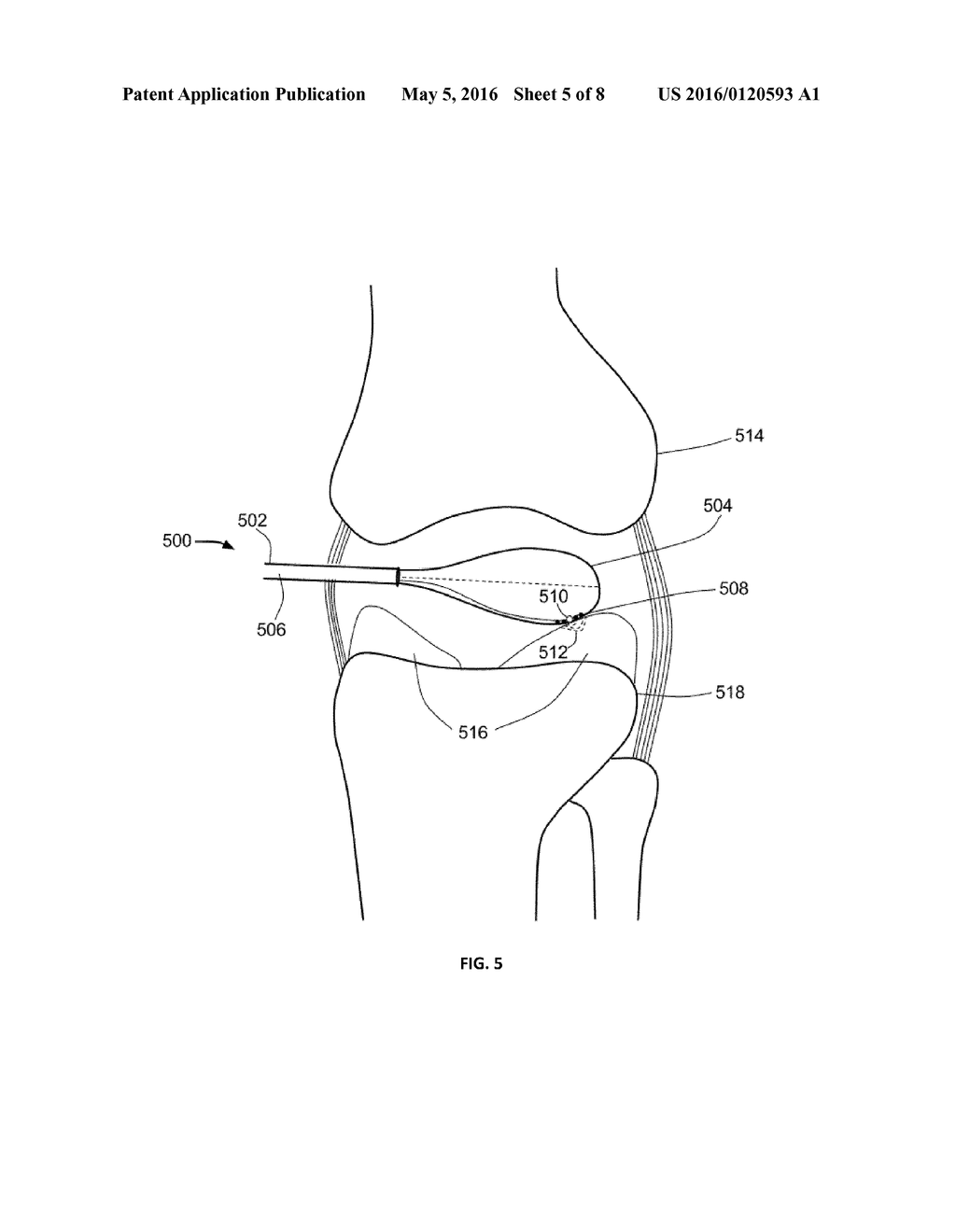 THERMALLY TREATING TORN TISSUE - diagram, schematic, and image 06