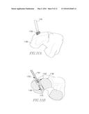 LIGAMENT SCREW ATTACHMENT DEVICE diagram and image