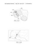 LIGAMENT SCREW ATTACHMENT DEVICE diagram and image