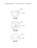 HEART AND PERIPHERAL VASCULAR VALVE REPLACEMENT IN CONJUNCTION WITH A     SUPPORT RING diagram and image