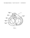 TRANSCATHETER CARDIAC VALVE PROSTHETIC diagram and image