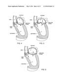 TRANSCATHETER CARDIAC VALVE PROSTHETIC diagram and image