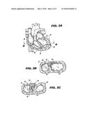 METHOD AND DEVICE FOR PERCUTANEOUS LEFT VENTRICULAR RECONSTRUCTION diagram and image