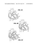METHOD AND DEVICE FOR PERCUTANEOUS LEFT VENTRICULAR RECONSTRUCTION diagram and image
