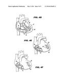 METHOD AND DEVICE FOR PERCUTANEOUS LEFT VENTRICULAR RECONSTRUCTION diagram and image