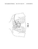 METHOD AND DEVICE FOR PERCUTANEOUS LEFT VENTRICULAR RECONSTRUCTION diagram and image