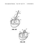 METHOD AND DEVICE FOR PERCUTANEOUS LEFT VENTRICULAR RECONSTRUCTION diagram and image