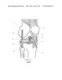 Total Knee Arthroplasty System and Method diagram and image