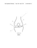 Total Knee Arthroplasty System and Method diagram and image