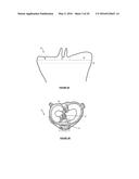 Total Knee Arthroplasty System and Method diagram and image