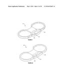 Total Knee Arthroplasty System and Method diagram and image