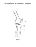 Total Knee Arthroplasty System and Method diagram and image