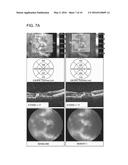 USE OF PEDF IN AN ENCAPSULATED CELL-BASED DELIVERY SYSTEM diagram and image