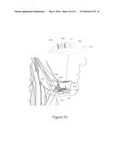 HYPERTENSION THERAPY IMPLANT APPARATUS diagram and image