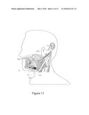 HYPERTENSION THERAPY IMPLANT APPARATUS diagram and image