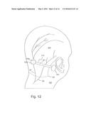 HYPERTENSION THERAPY IMPLANT APPARATUS diagram and image