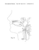 HYPERTENSION THERAPY IMPLANT APPARATUS diagram and image