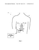 PAIRED STIMULATION PULSES BASED ON SENSED COMPOUND ACTION POTENTIAL diagram and image