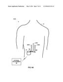 PAIRED STIMULATION PULSES BASED ON SENSED COMPOUND ACTION POTENTIAL diagram and image