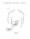 PAIRED STIMULATION PULSES BASED ON SENSED COMPOUND ACTION POTENTIAL diagram and image